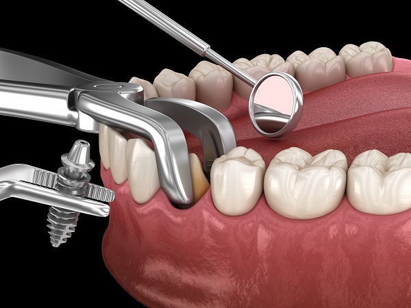 Dental Implants Wilmington, DE