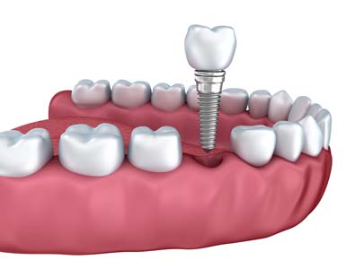 Dental Implants in Wilmington